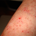 Effective Treatments for Morgellons Disease